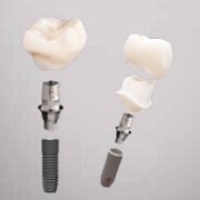 CEREC for Implantology