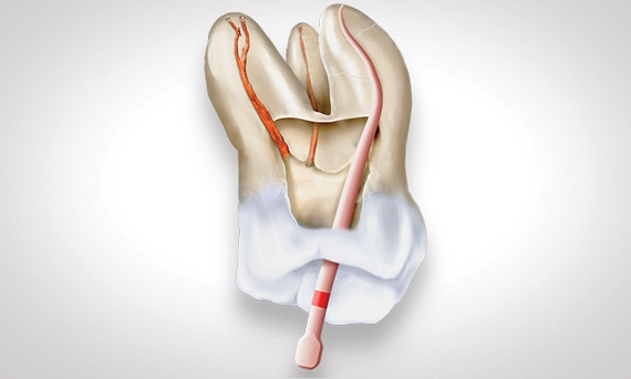 Conform Fit Gutta-Percha Cones and Cartridges