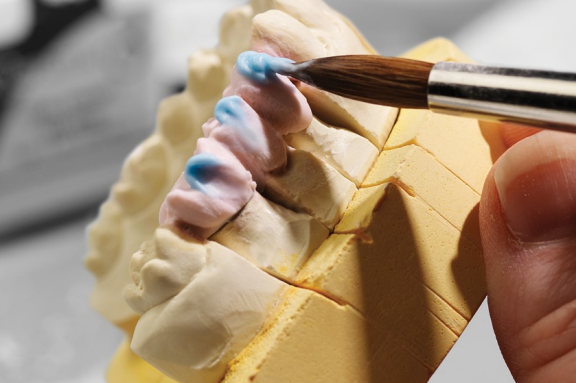 Dental Lab Metal-based Veneering Systems