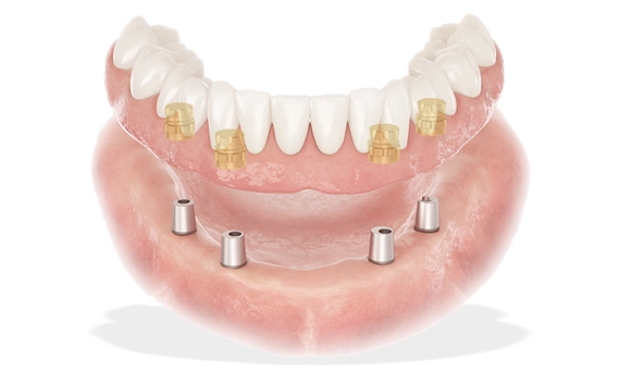 Lucitone 199 Denture Base Resin