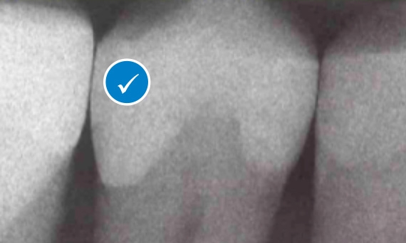 Restoration  using Palodent 360 Circumferential dental matrix band