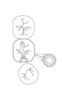 using dental matrix band for misaligned tooth