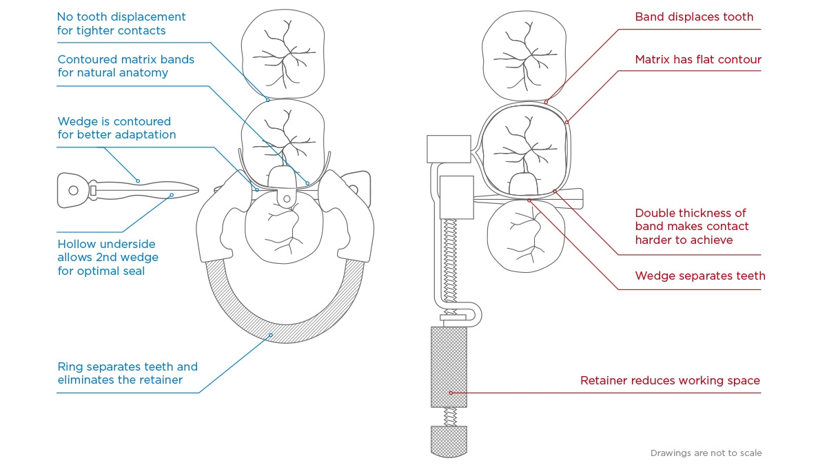 Sectional System vs circumferential matrix