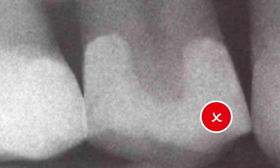 Downsides of Tofflemire circumferential band