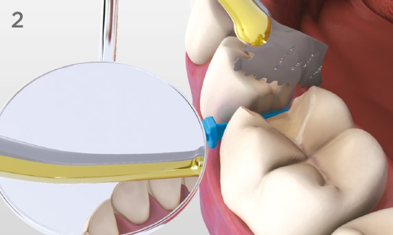 Support wedge with mirror or dental instrument