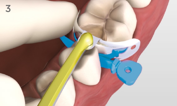 Place Palodent Plus with tweezers