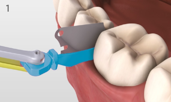 Palodent plus Wedge placed from the lingual or buccal side for prep